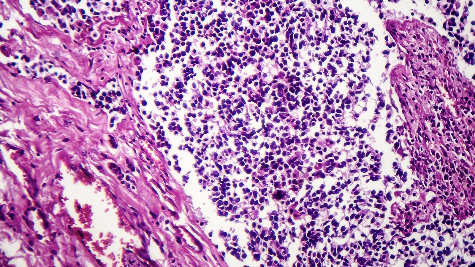 What is small cell lung cancer?