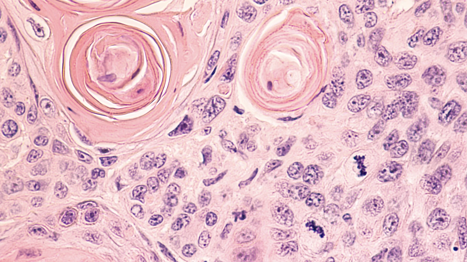 What is non-small cell lung cancer?